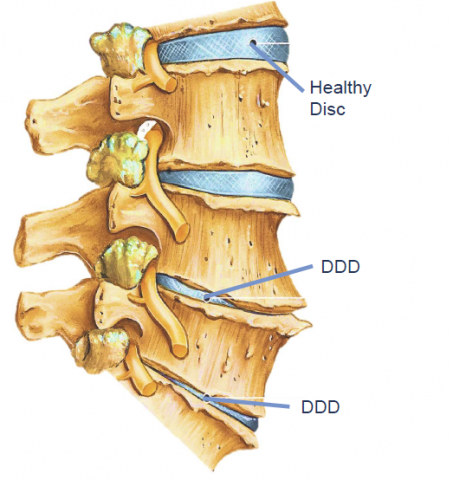 low-back-pain